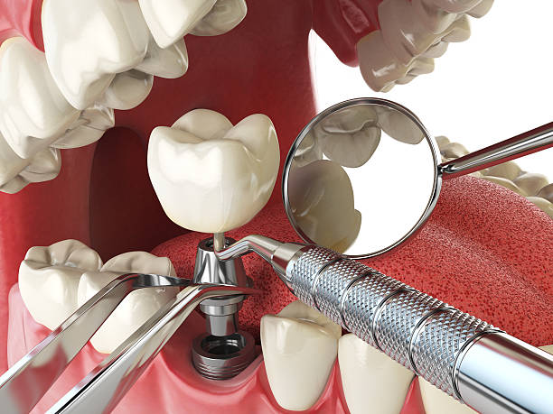 Best Emergency Wisdom Tooth Extraction in Janesville, CA